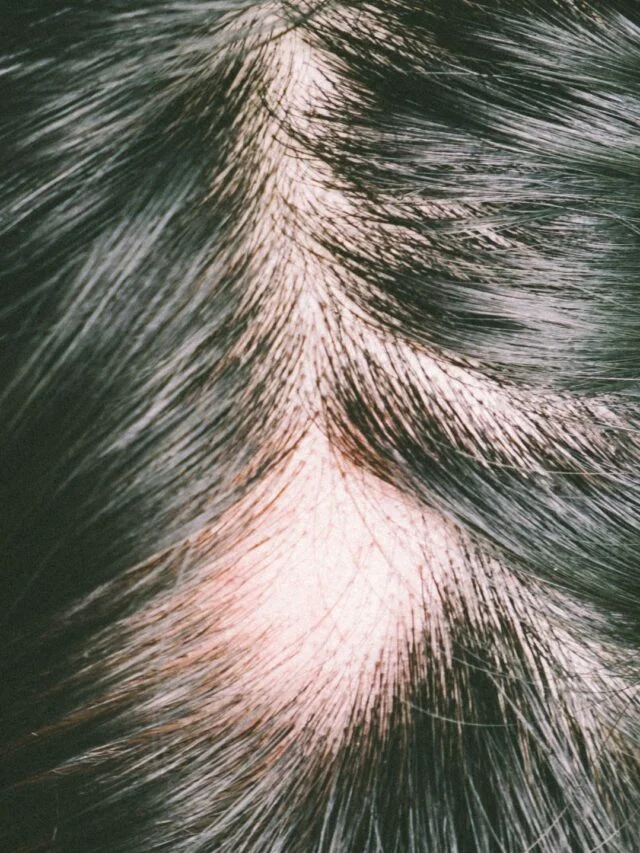 Como é a queda de cabelo por ansiedade?